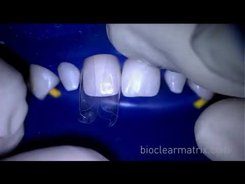 Bioclear Composite Veneers for Undersized Teeth  Part 1
