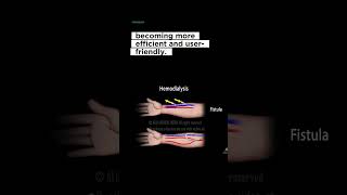 🚀 Evolution of Dialysis Machines: Enhanced Efficiency & User-Friendly Features! 😃