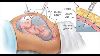 Fetal fluid drainage CPT code - simplify medical coding