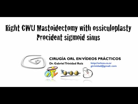 CWU MASTOIDECTOMY WITH OSSICULOPLASTY