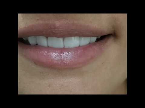(Before/After) Porcelain veneers in Cartagena, Colombia by Dr. Julio Oliver