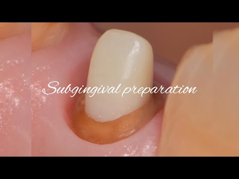 Subgingival preparation〜provisional restoration