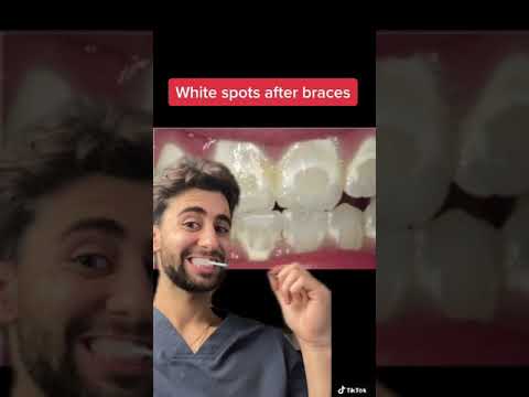 protect your teeth and braces #shorts