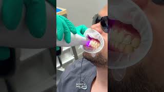 Digital Scanning and No More Impressions for Clear Aligners!