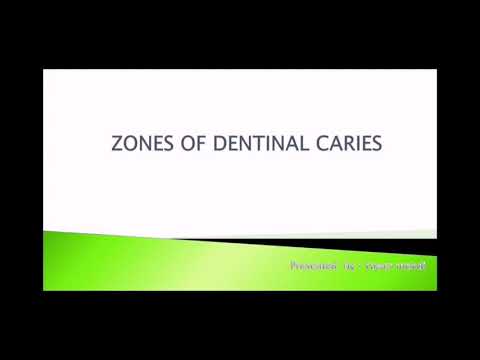 Zone of dentinal caries