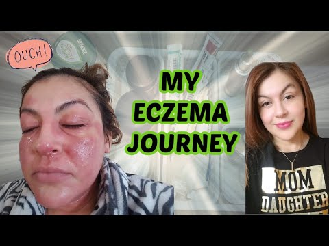 Living with Eczema | #ECZEMA | #ATOPIC DERMATITIS