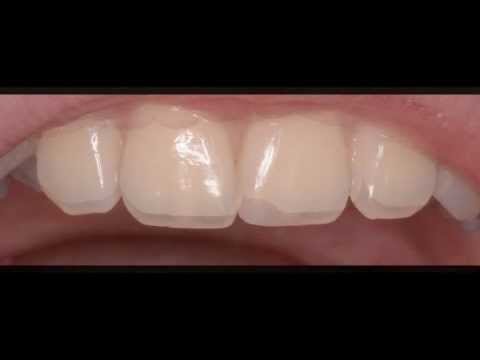 Реставрация зуба [teeth restorations]