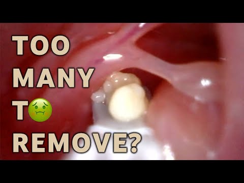 Removing WAY too MANY Tonsil Stones | AIM 12
