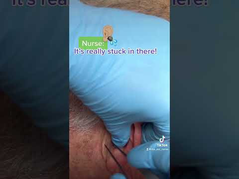 This one was as stubborn as they come! 😬 #earwaxremoval #earpicking