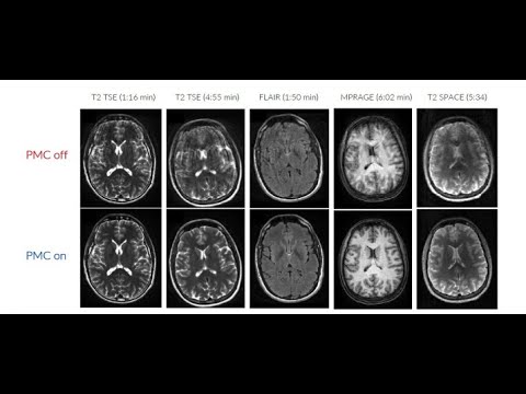 TCL : Prospective/Retrospective Motion correction solution for MRI scanner