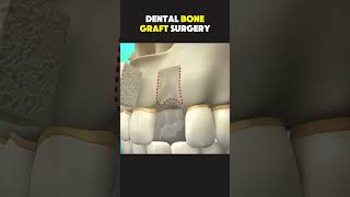 Dental bone graft surgery #treatmentforallbodyparts #bodytreatment #dentaltips #doctor