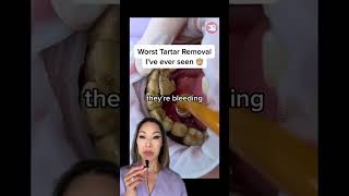 Heavy Tartar Removal #shorts