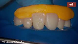 Anterior Direct Restoration with Zenit Composite by Dr. Anton Vetchinkin