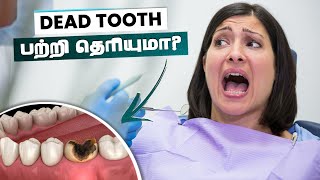 Dead Tooth 🦷 | Dr. Irfana Sulthan