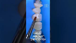 Dental motivation. Direct composite restoration teeth. Composite veneers. #veneers #dentistry