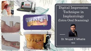 Digital Impression Technique in Implantology (Intra Oral Scanning)