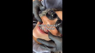 Worst Snacks For Braces 😬