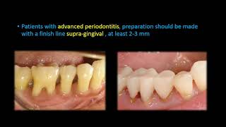 Clinical tips for marginal integrity. Dr. Taher Khattab