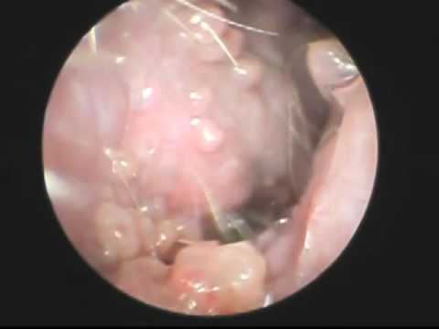 Video-otoscopy. Ear Masses.