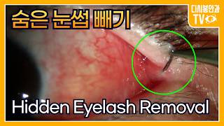 Hidden Eyelash Removal