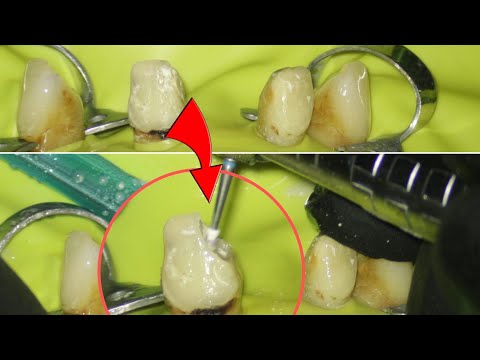 Unbelievable Restoration: Front Teeth After Root Canal Treatment