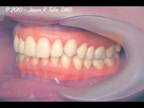 Invisalign - Before and After - Closing Spaces - Dr. Jason Tubo - Northbridge Dentist