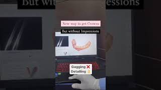 Digital Scans means No More Impressions // 5d scanning // Smile makeover with aesthetic crowns.