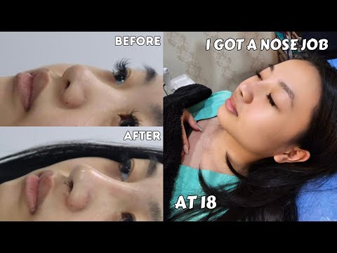 GETTING A NOSE JOB AT 18 IN THAILAND | RHINOPLASTY  VLOG | DOCUMENTING, RECOVERY, COST AND RESULTS