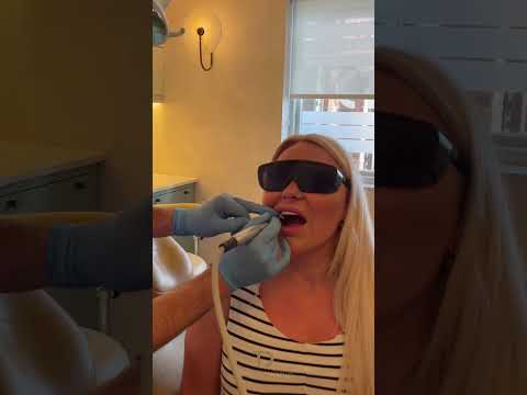 Transformation 😍 3D Prited Composite Veneers #teeth #cosmetics #trending #transformation