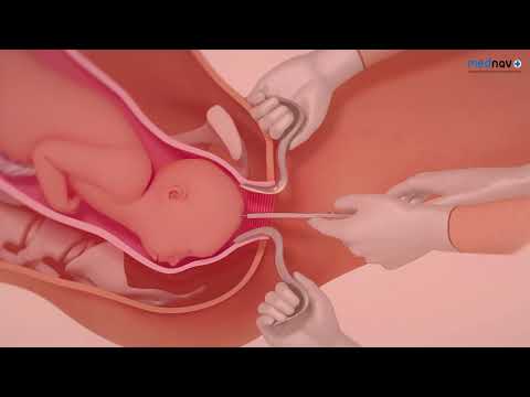 Destructive delivery