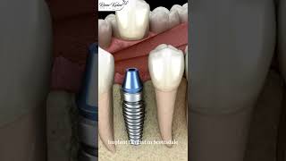 Implant Dentist in Scottsdale | #scottsdale #dentalimplants #dentist