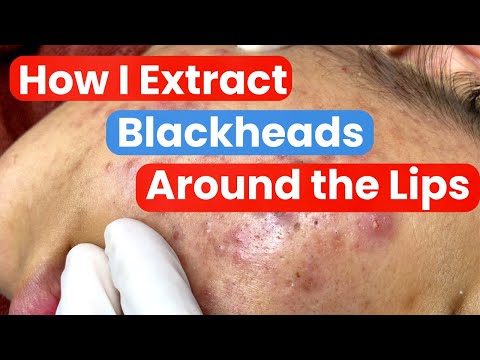 Extreme Blackhead Extractions Around the Lips