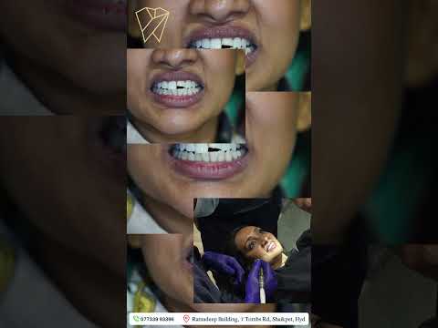 Transform Your Smile with Composite Fillings | Natural, Painless & Beautiful! | #dentalclinic