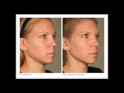 Ultherapy Face Lift Wallingford CT 203-284-1119