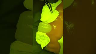 Composite Injection Technique