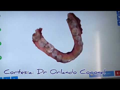 Single Tooth Implant Case Shared by Dr. Orlando