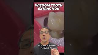 What to Expect When Extracting Wisdom Teeth | In Office to Hands On Dental Training