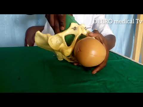 Mechanism of occipital posterior position