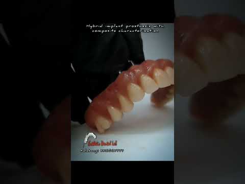 hybrid implant denture      #kalaburagi #dentaltechnician #indiandentist #dentalimplants #dentallab