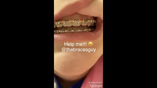 Twisty Hooks On Braces?!?!  Here's What They Are Used For!