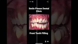 #smilecorrection at #Smilepleasedentalclinic
