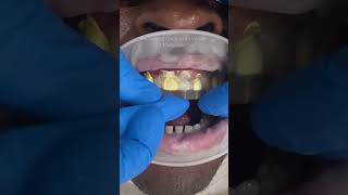 No drilling composite veneer technique 🤍