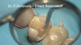 Complex direct restoration