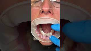 When composite veneers look this good😍Dr Alex showcasing the Injection Mould technique🙌