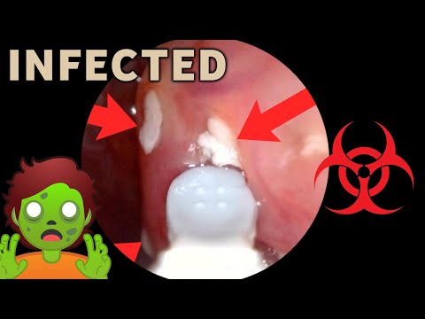 Strep INFECTED Tonsils (SERIOUS) | AIM 24