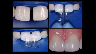 Bioclear - Diastema Closure