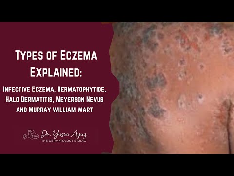 Lecture 5: Types of Eczema