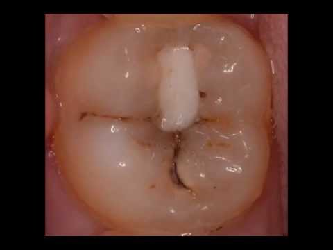 Лечение кариеса [caries decay treatment]