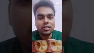 दांतों के कीड़े का इलाज | Treatment of dental worms