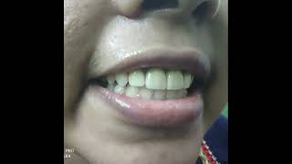 Smile correction treatment